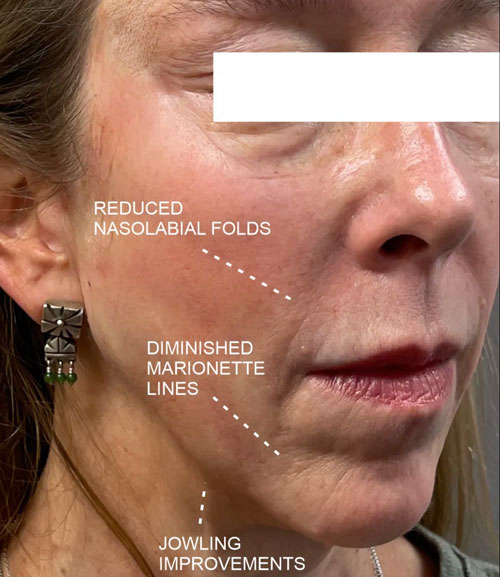 pdo thread lift after